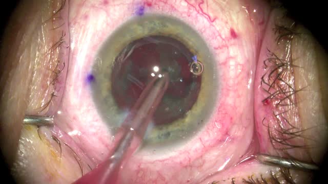Piece Out: Cylinder Size in LACS Impacts Nuclear Removal