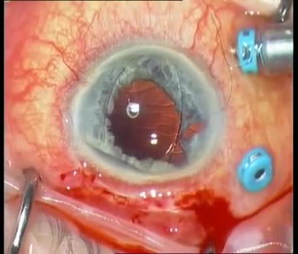 Iridoplasty and Iris-claw Implantation for Traumatic Mydriasis and Aphakia