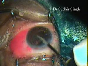 IOL Implatation After Posterior Capsule Rupture