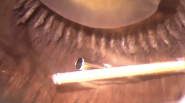 Early Vitrectomy Effects on the Vitreous Base