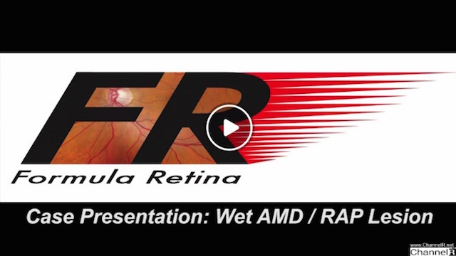 Case Presentation- Wet AMD-RAP Lesion