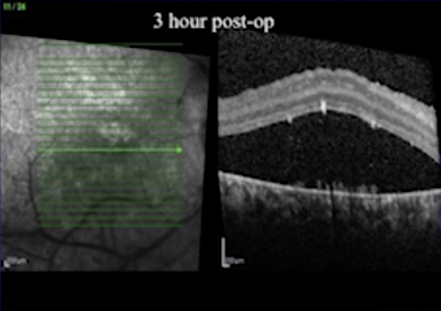 Allogenic Ectomesenchymal Stem Cell Transplantation