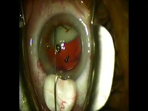 Trans-zonular TriMoxi Technique