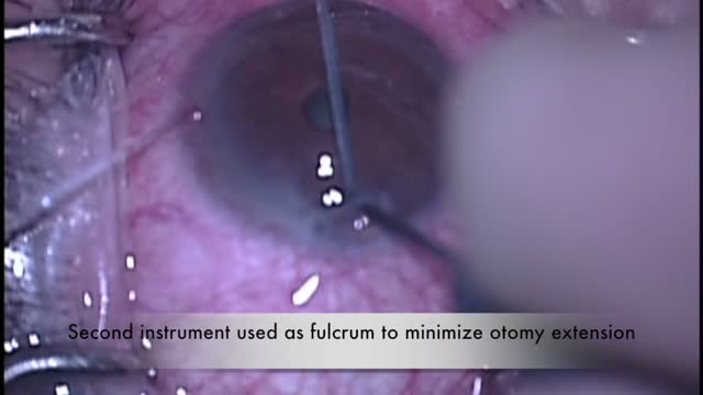 Ab-Interno Canaloplasty (ABiC)