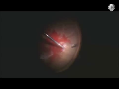 Unimanual Diabetic Tractional Retinal Detachment Repair