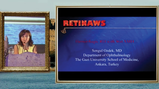 Hemorrhagic RD with Wet AMD