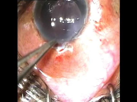 Management of Traumatic Subluxated Cataract and Intractable Angle Recession Glaucoma in a Young Adult