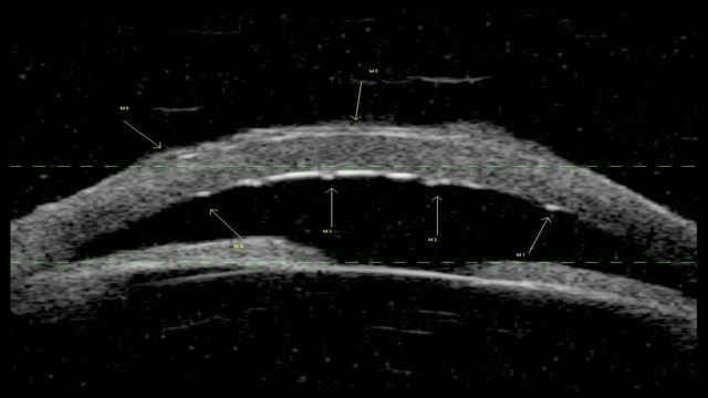 Image Acquisition and Exam Technique for Ultrasound Biomicroscopy with Quantel UBM Systems