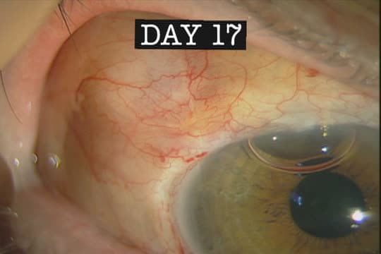 Molteno III 245 Tube Placement