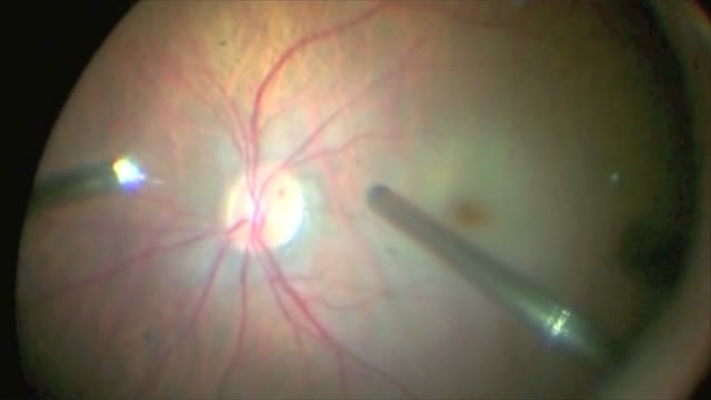 Novel Technique Using Arterial Sheathotomy as a Primary Treatment for CRAO