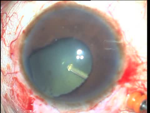 Retinal Detachment Surgery In Typical and Atypical Coloboma Cases