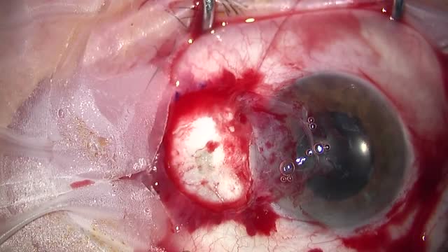 Pterygium with Autograft