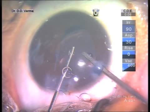 Management of Infantile Traumatic Cataract