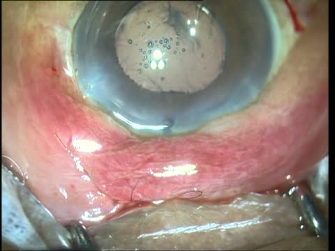Step by Step SIGS with Pre-Op MMC with Phacoemulsification 