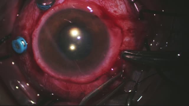 Repair of Progressive Retinal Detachment Associated With Retinoschisis