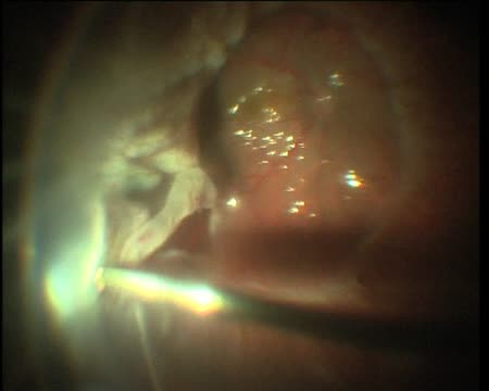 Close Funnel Retinal Detachment