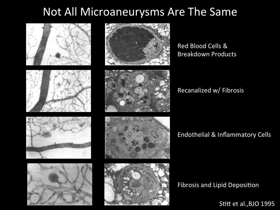 Appearance of Microaneurysms on OCT Angiography 