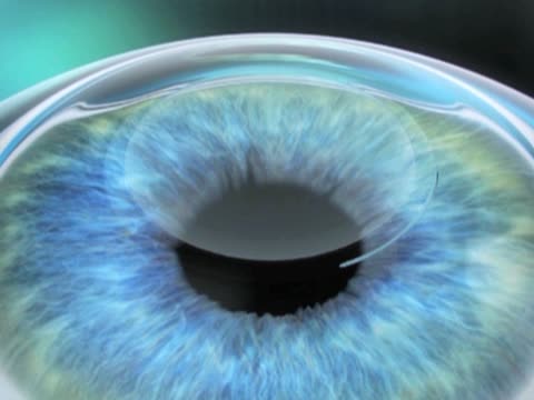 PrEsbyopic Allogenic Refractive Lenticule (PEARL)