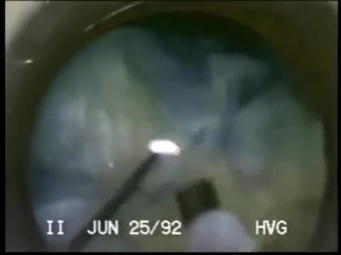 Blunting an Anterior capsule tear