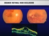 Navigated Grid Laser Treatment After Bevacizumab Failure in BRVO