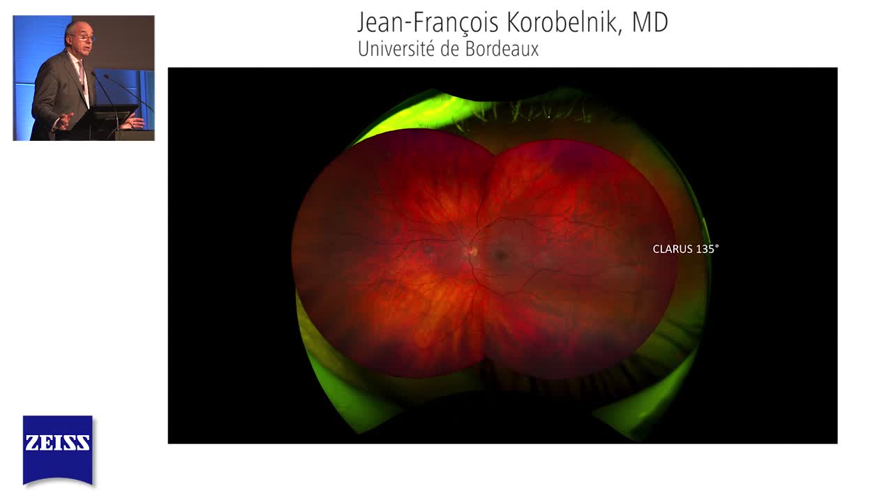 How Does the CLARUS 500 Compare to Legacy Ultra-Widefield Systems in Terms of Field of View?