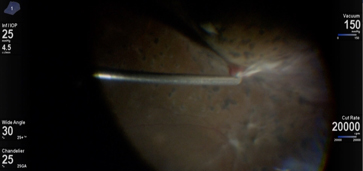 HYPERVIT Controlled Peripheral Shaving