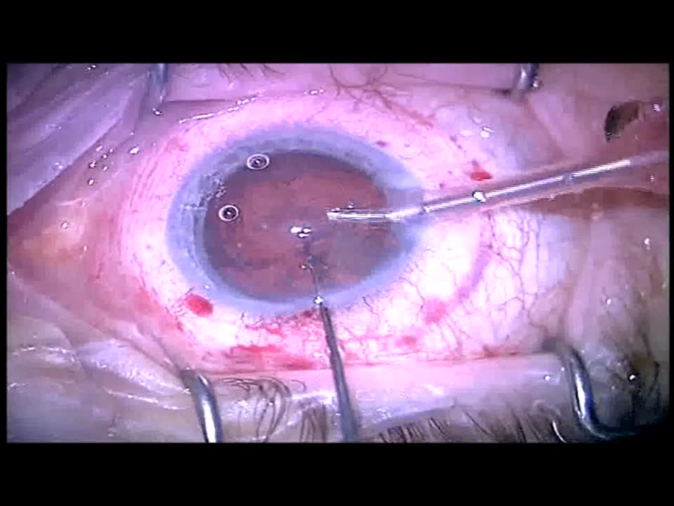 Femtosecond Cataract Extraction After Flap Amputation