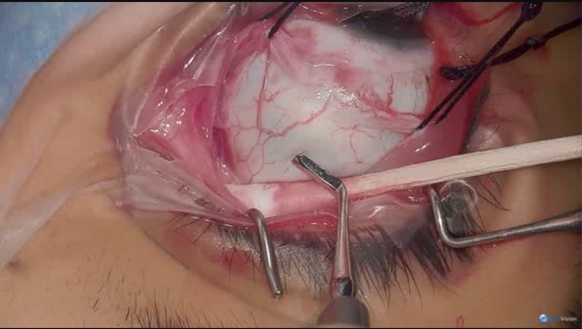 Buckle with Ngenuity