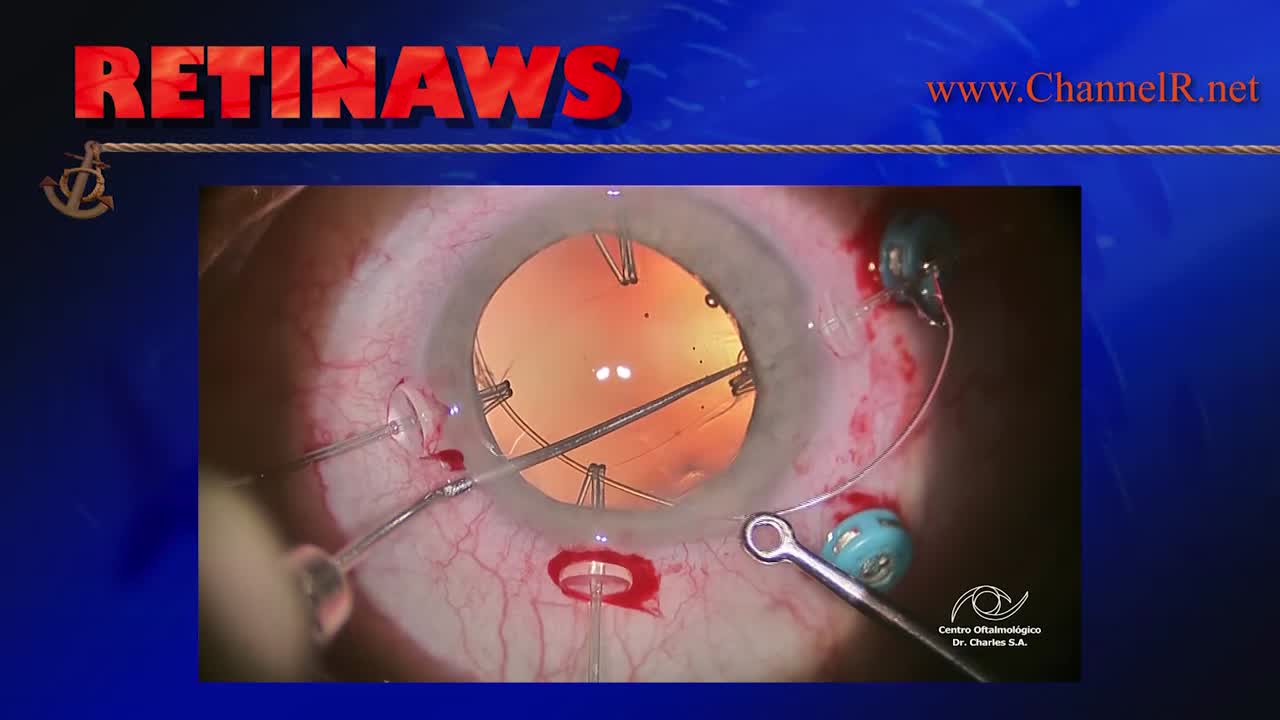 Traumatic Cataract