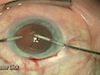 Cortex Aspiration After Laser Refractive Cataract Surgery