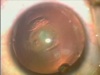 Posterior Lenticonus - Part 1