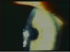 Wydase Keratopathy