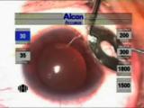23-gauge Bimanual Surgery for PDR