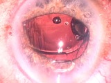 Sulcus Implantation Following Posterior Capsular Tear