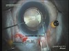 Strategies for IOL Explantation