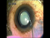 MICS in a White Cataract