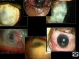 Combined Vitrectomy and penetrating keratoplasty for complex cases