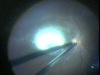 Induction of Posterior Vitreous Detachment II