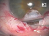 Routine Canaloplasty