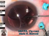 Iris-Sutured IOL with 25G Instrumentation