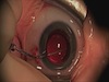 Cataract Surgery, PPV, and IOL Implantation in an Infant