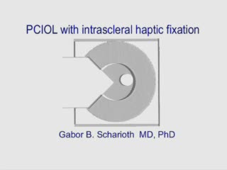 PCIOL with Intrascleral Haptic Fixation