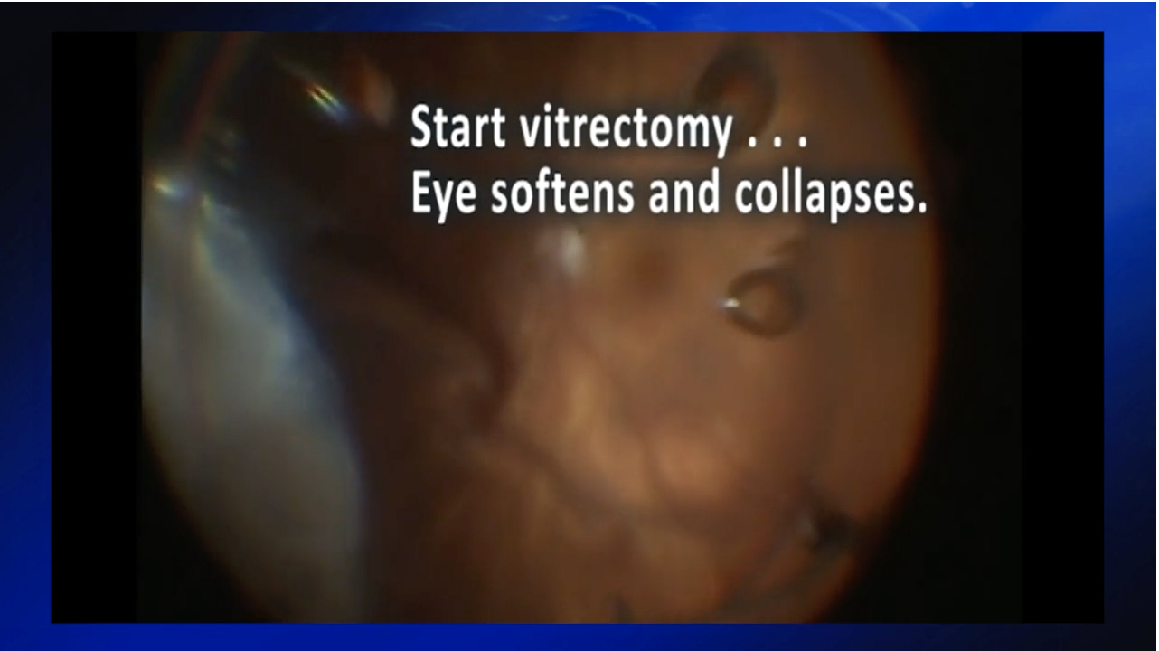 Floaterectomy