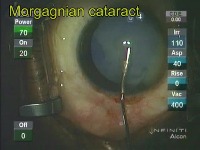 Morgagnian Cataract 
