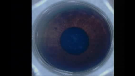 Flap Creation With the iFS Femtosecond Laser