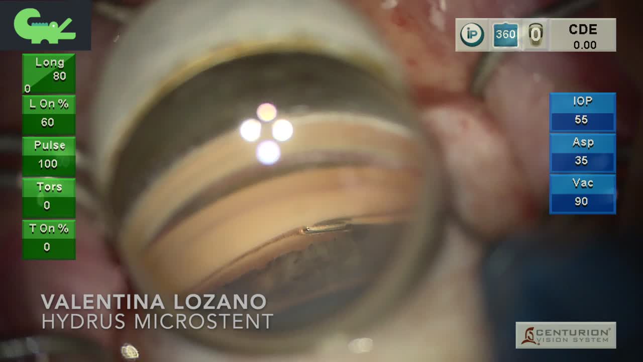 Placement of a Hydrus Microstent