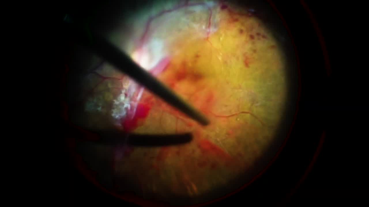 Severe Epipapilar Fibrosis in Advanced Proliferative Diabetic Retinopathy