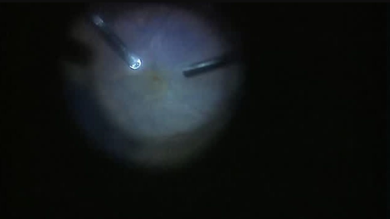 Negative Staining to Differentiate ILM, ERM [FLOREtina Live Surgery]