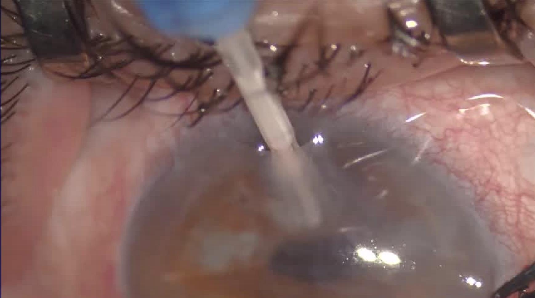 Anterior Chamber Ozurdex