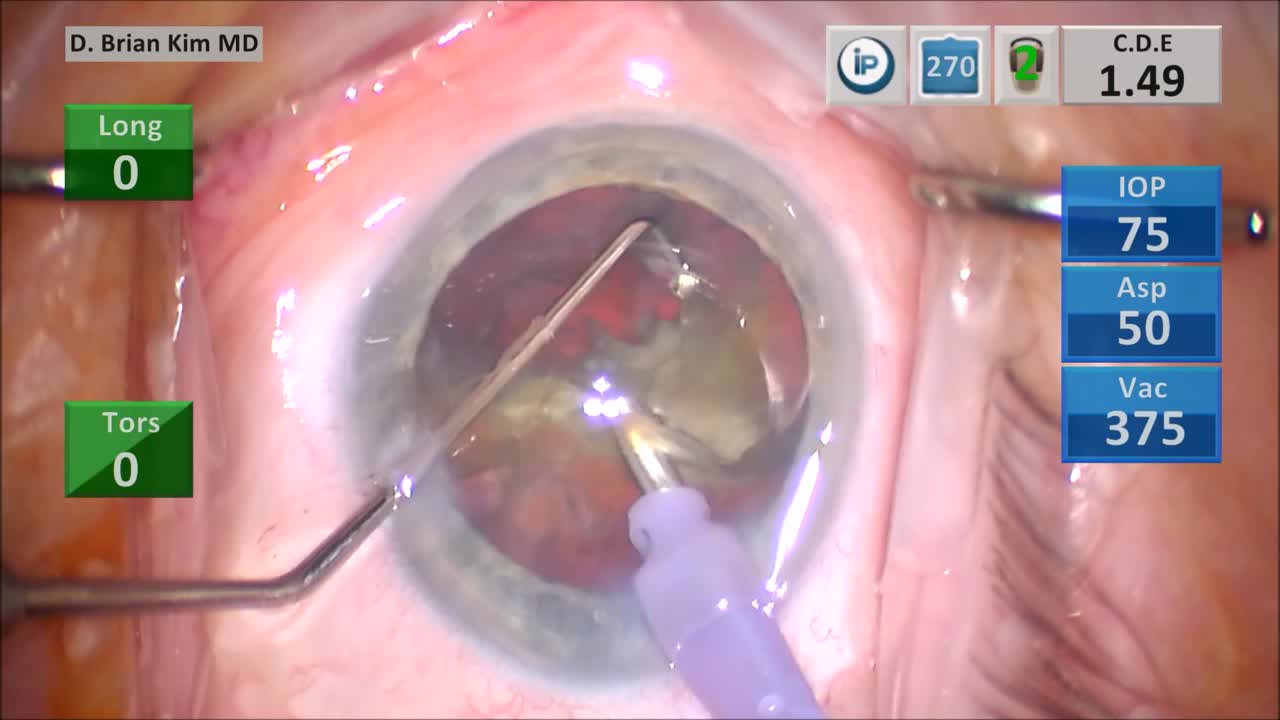 Dense Cataract and Zonulopathy: Double Chop and Cross Chop Lens Disassembly Technique